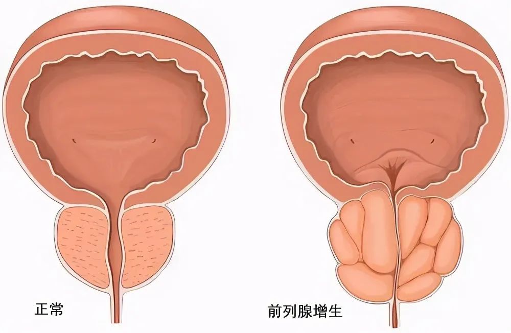 前列腺最新治疗技术，开启健康之门的创新疗法